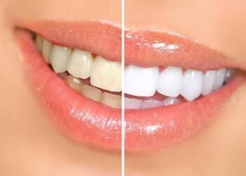 How Can I Maintain My Teeth Whitening Results?
