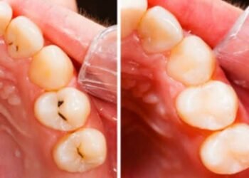 How Do I Care for My Tooth-Coloured Fillings?